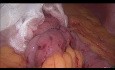Mini-Bybass Gastrique: Test de Lachage de l'Anastomose 