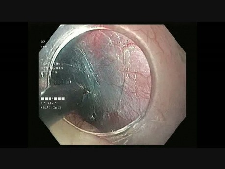 Résection endoscopique sous-muqueuse par technique du tunnel d'un léiomyome de l'oesophage