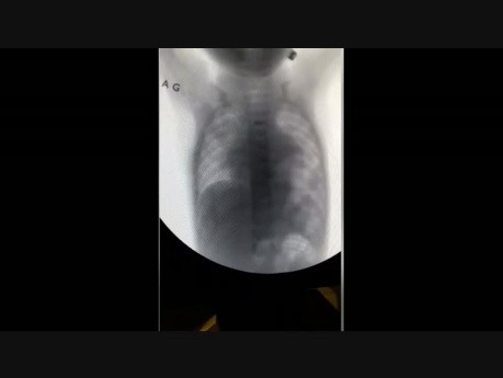 Mouvement paradoxal du diaphragme 