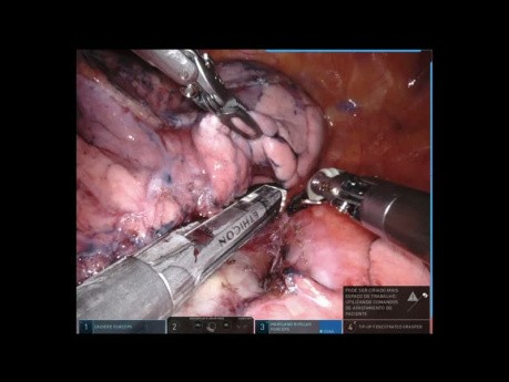 Résection assistée par robot - lobe supérieur gauche