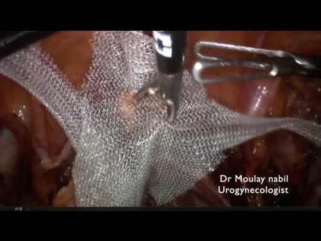 La Pectopexie -Chirurgie du Prolapsus chez une Patiente de 80 ans