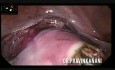 Le fibrome cervical