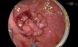 Microchirurgie Mini-Invasive (TEM) pour le Cancer du Rectum. Approche Chirurgicale Etape par Etape.