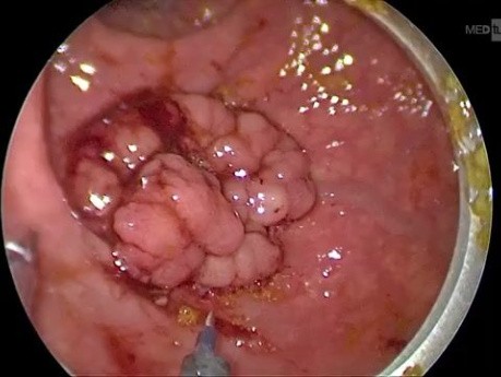 Microchirurgie Mini-Invasive (TEM) pour le Cancer du Rectum. Approche Chirurgicale Etape par Etape.