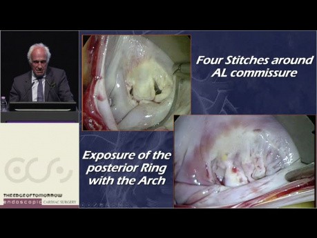 Conférence du Dr Hugo Vanermen pour le Lifetime Achievement Award lors du forum inaugural de la réunion du club des chirurgiens cardiaques endoscopiques à Thessalonique 2022