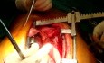 Revascularisation myocardique sans circulation extracorporelle (sur le cœur qui bat)