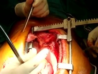 Revascularisation myocardique sans circulation extracorporelle (sur le cœur qui bat)