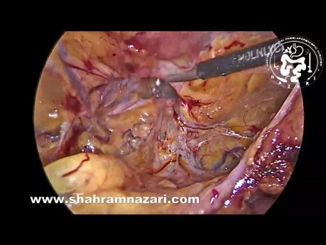 Réparation d'une hernie inguinale récurrente par incision gauche