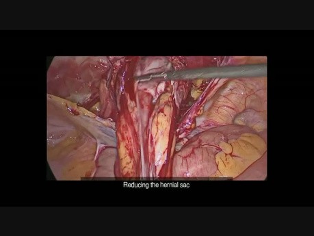 Chirurgie de hernie inguinale par voie trans-abdominal pré-péritonéal (TAPP) avec la mise en place d'un filet