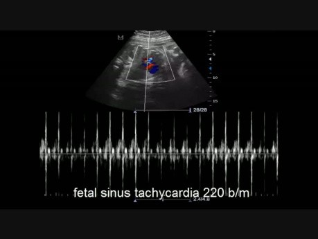Tachycardie sinusale fœtale 