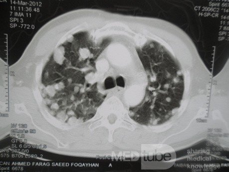 Le carcinome à cellules rénales (CCR)  - métastases thoraciques 2.