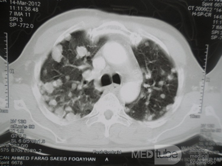 Le carcinome à cellules rénales (CCR)  - métastases thoraciques 2.