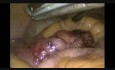 Vidéo non coupée de la résection laparoscopique du saignement du diverticule de Meckel