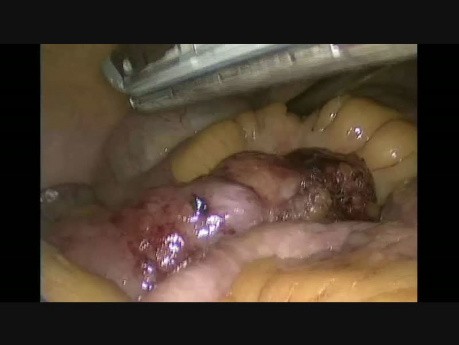 Vidéo non coupée de la résection laparoscopique du saignement du diverticule de Meckel