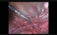 Hystérectomie laparoscopique en raison des douleurs abdomino-pelviennes chroniques