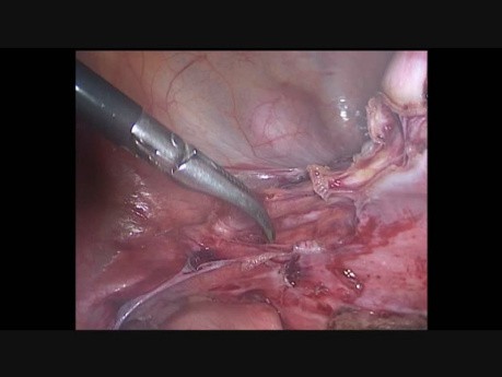 Hystérectomie laparoscopique en raison des douleurs abdomino-pelviennes chroniques