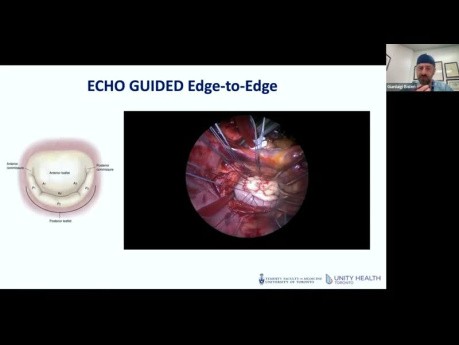 Écho et Chirurgie Cardiaque Mini-Invasive pour la Valve Mitrale - Ce Qu'on Doit Savoir