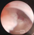  Ventriculostomie endoscopique du troisième ventricule dans un cas bénin du syndrome d'Aicardi avec hydrocéphalie obstructive et malformation de Chiari de type 1.