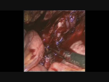 Contrôle des saignements aortiques par laparoscopie après lymphadénectomie paraortique laparoscopique à cause du cancer du côlon gauche