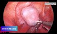 Ovariectomie laparoscopique chez un enfant de 3 ans