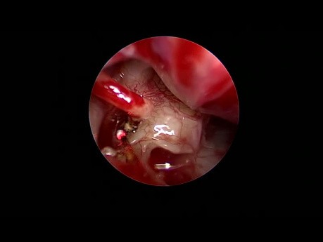 Stapédotomie Endoscopique pour Otospongiose (Laser à Diode)