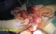 Extraction de Fibrome