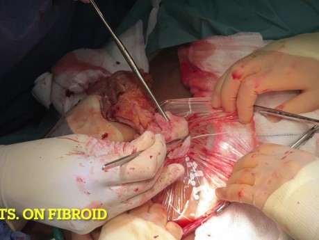 Extraction de Fibrome
