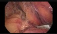 Hémicolectomie gauche par voie laparoscopique pour le cancer de l'angle colique gauche