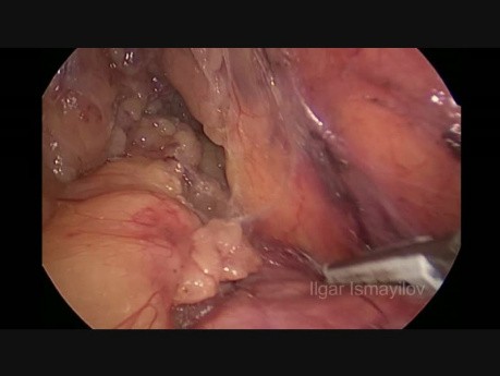 Hémicolectomie gauche par voie laparoscopique pour le cancer de l'angle colique gauche