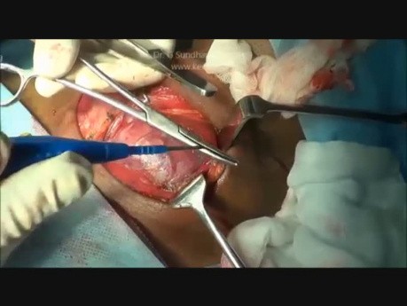 Thyroïdectomie totale pour le goitre multinodulaire