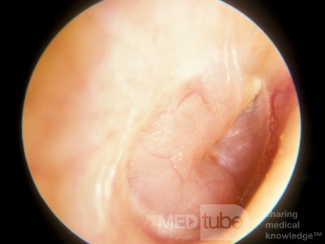 Neurinome acoustique de l'oreille moyenne