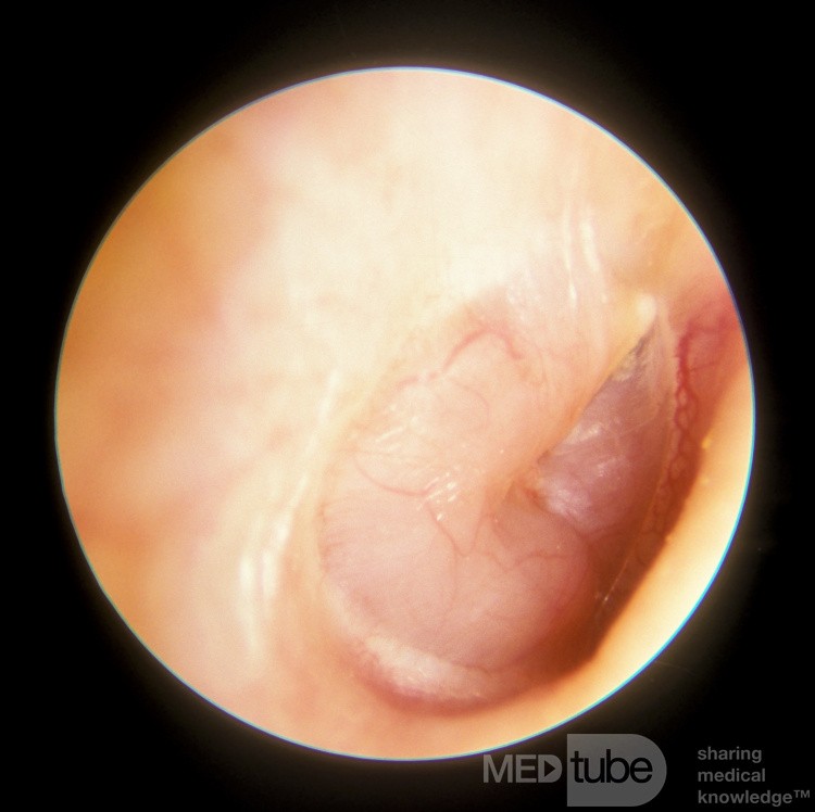 Neurinome acoustique de l'oreille moyenne