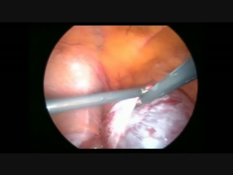 Cystadénome de l'ovaire - exérèse laparoscopique
