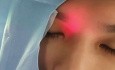 Transillumination des Sinus Frontaux à l'Aide d'un Guide de Lumière pour Sinusoplastie au Ballonnet