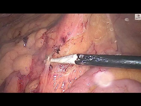 Hémicolectomie gauche laparoscopique pour cancer du sigmoïde : approche par étapes