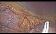 Spléno-pancréatectomie gauche laparoscopique