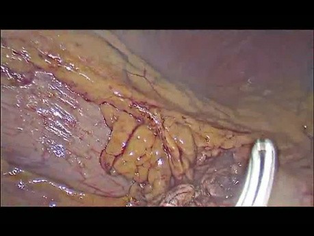 Spléno-pancréatectomie gauche laparoscopique