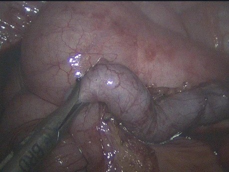 Dissection de la base appendiculaire