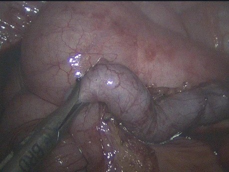 Dissection de la base appendiculaire