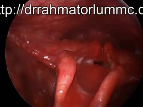 Sténose Supraglottique (Rétrécissement du Larynx) suite à un Accident de la Voie Publique 