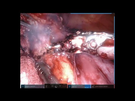 Tératome médiastinal (chirurgie robot-assistée)