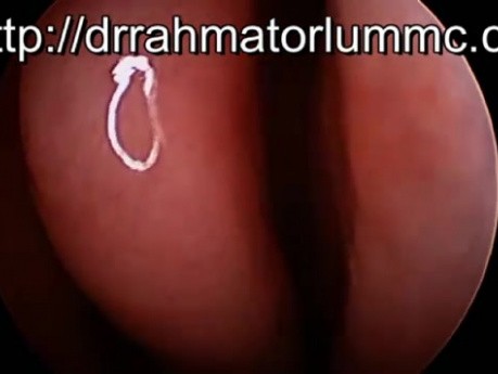 Perforation de la Cloison Nasale en HD