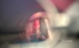 Révision chirurgicale d'un cancer des cordes vocales