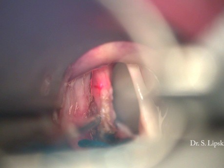 Révision chirurgicale d'un cancer des cordes vocales