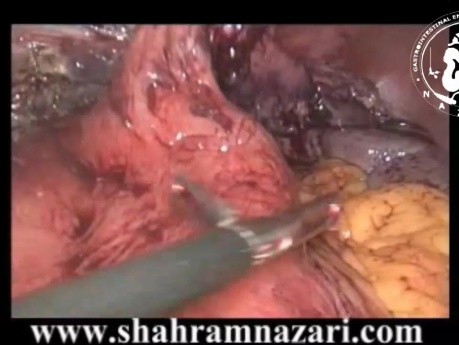 Gastroplastie Laparoscopique de Collis et Fundoplicature de Nissen