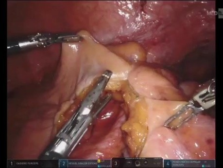 Utilisation du Vert d'Indocianine (ICG) en Chirurgie Colorectale à l'Aide d'un Robot dans l'Anastomose Colorectale Basse