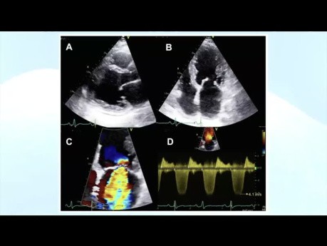 Évaluation Echocardiographique des Cardiopathies Rhumatismales
