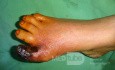 La gangrène sèche localisée du pied, l'ischémie.