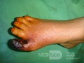 La gangrène sèche localisée du pied, l'ischémie.