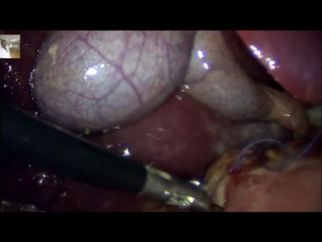 Peritonite Par Perforation Ulcere Gastroduodénale; Traitement Par Voie Laparoscopique 